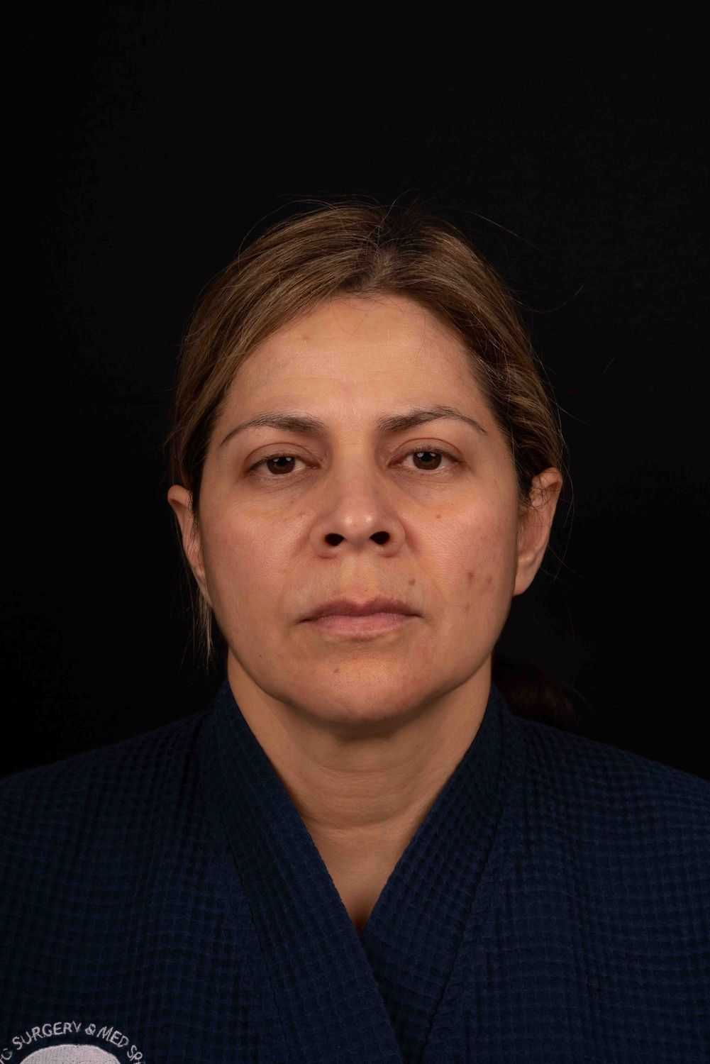 Facelift Before & After