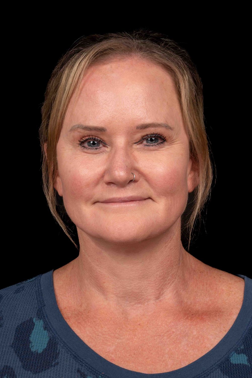 Facelift Before & After