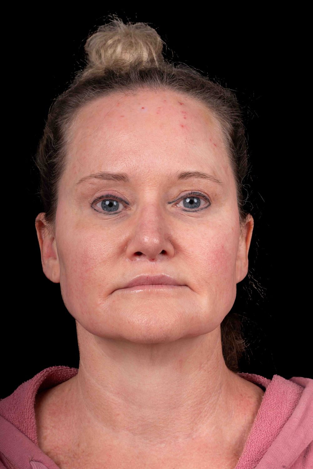 Facelift Before & After