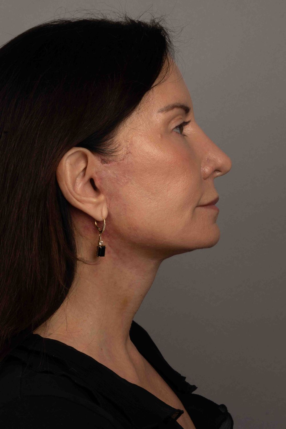 Facelift Before & After