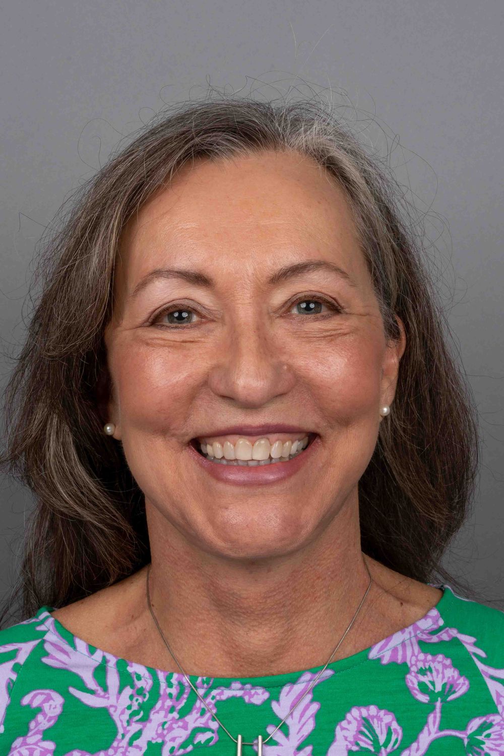 Facelift Before & After