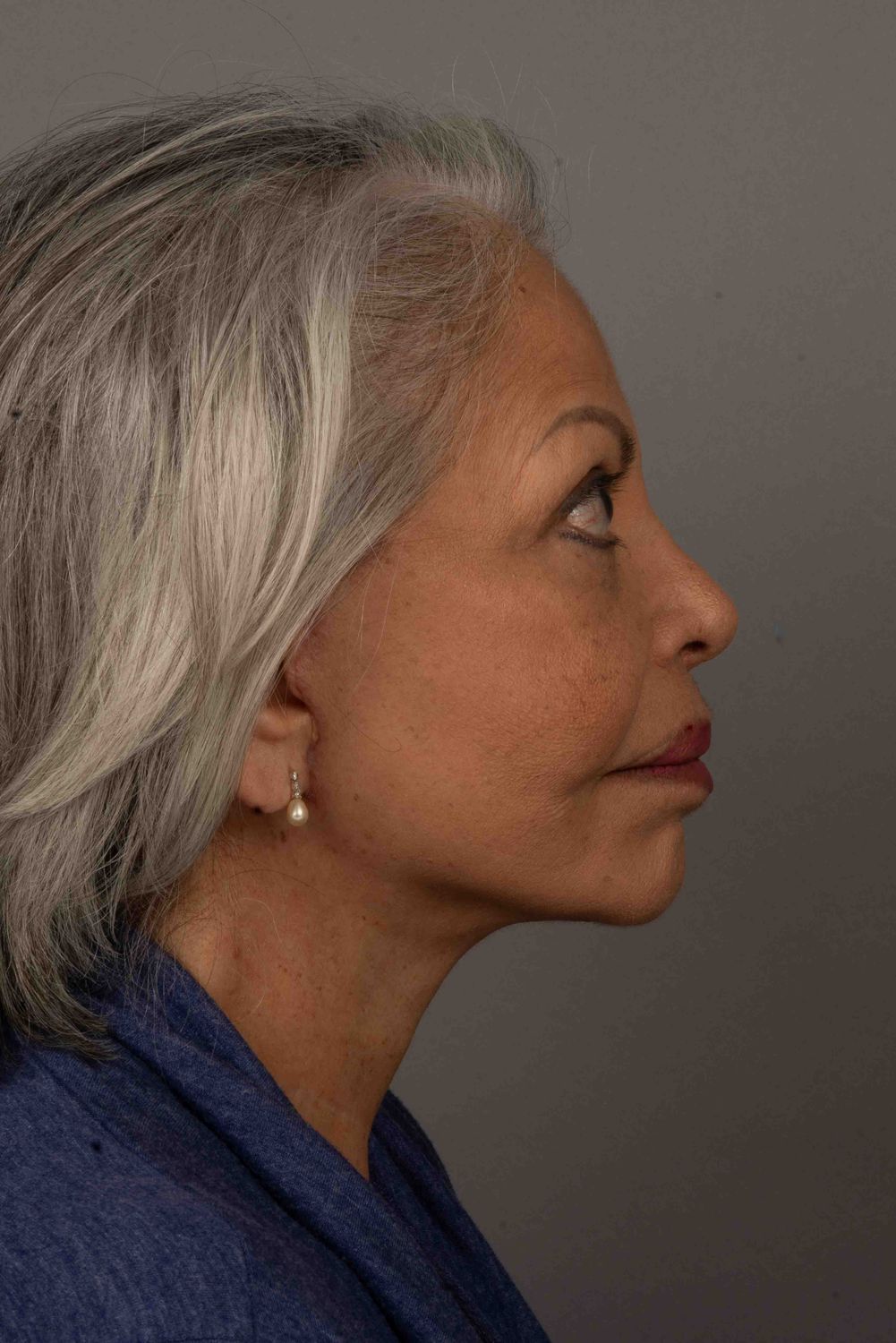 Facelift Before & After