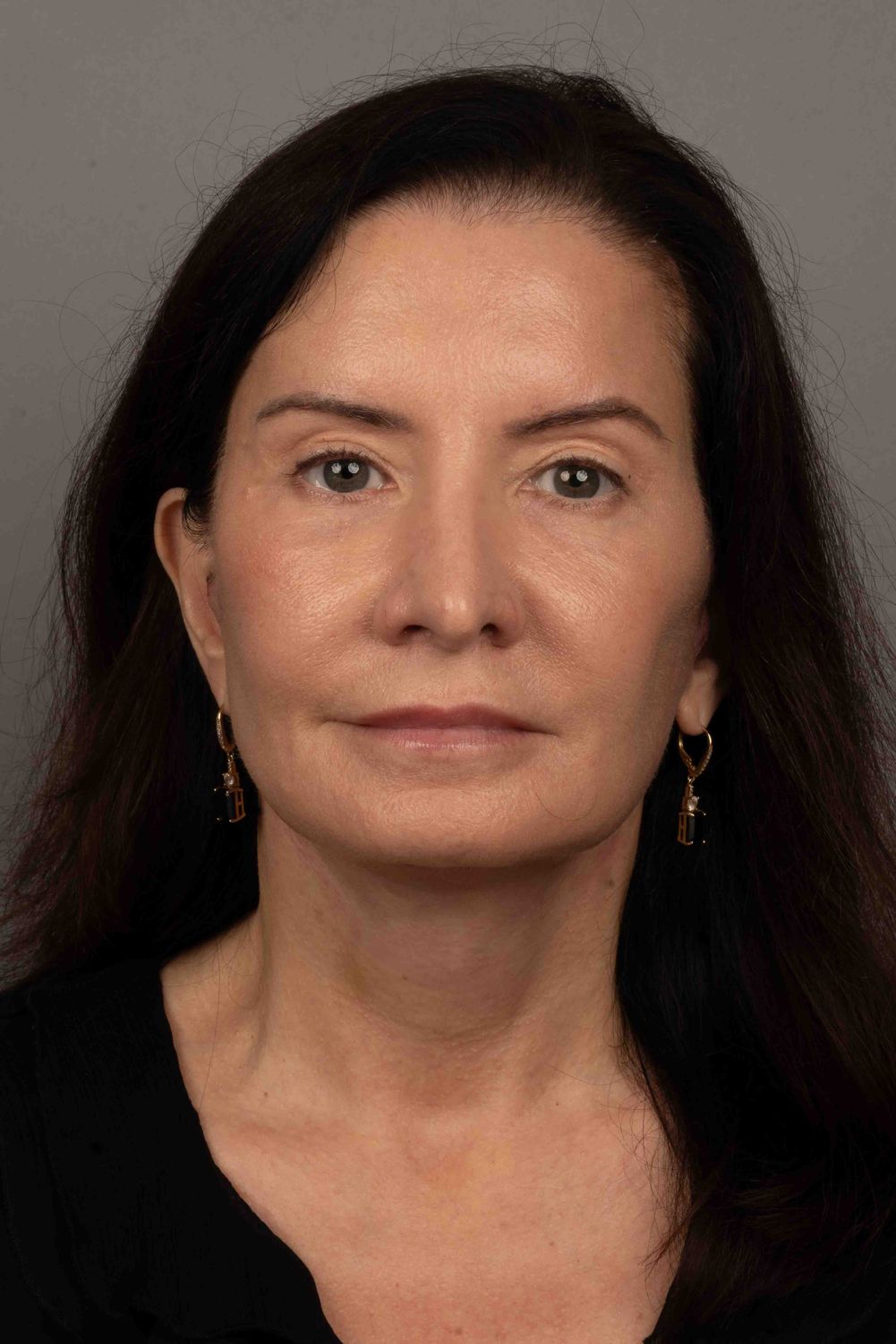 Facelift Before & After