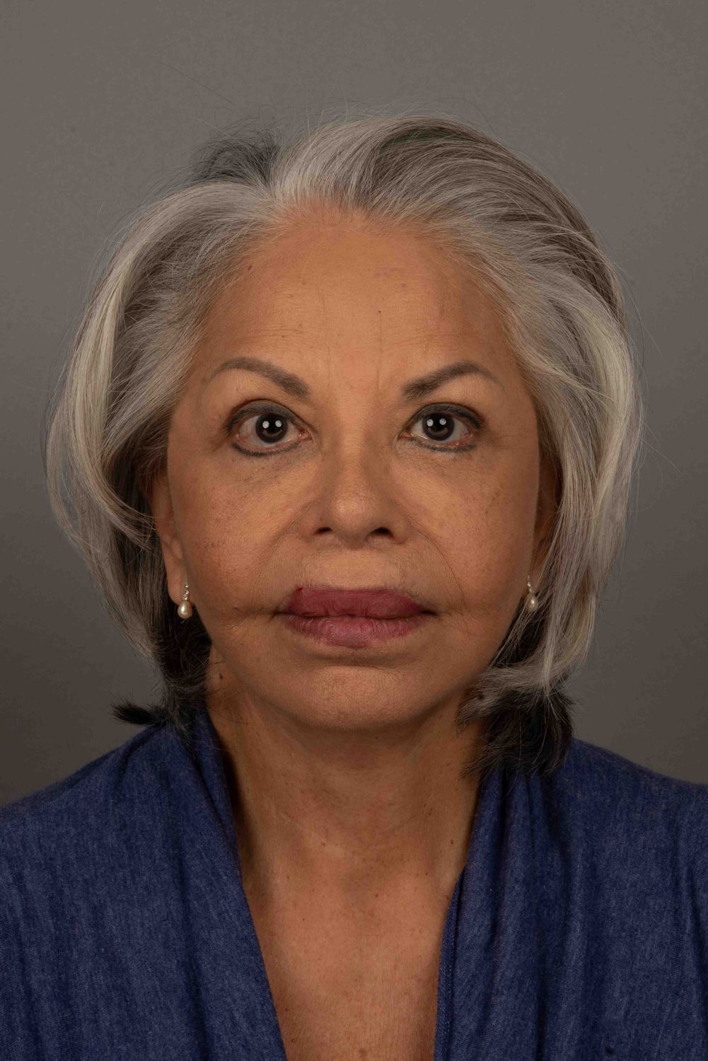 Facelift Before & After