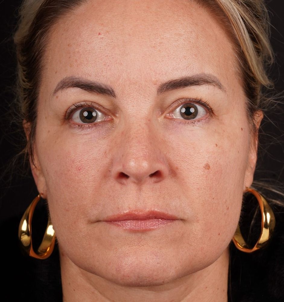 Facelift Before & After