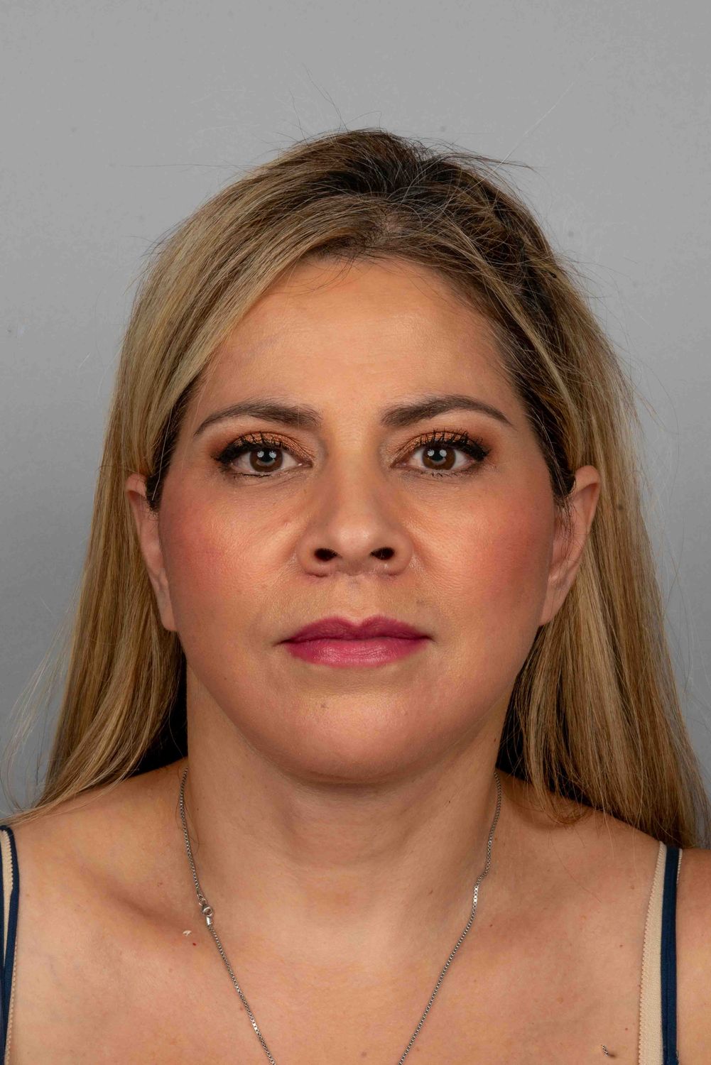 Facelift Before & After