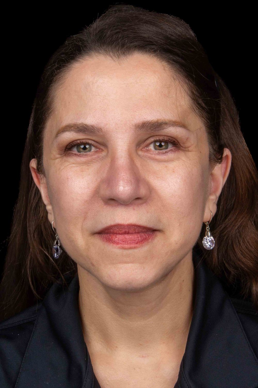 Facelift Before & After