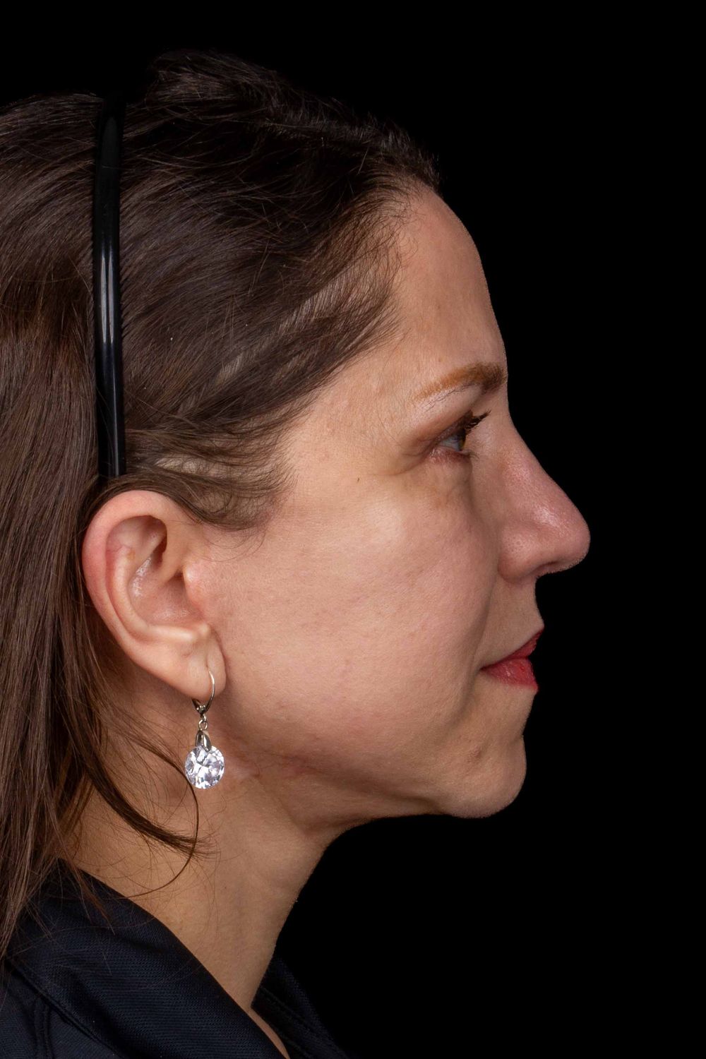 Facelift Before & After