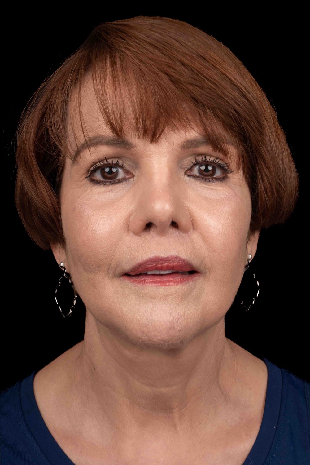 Facelift Before & After