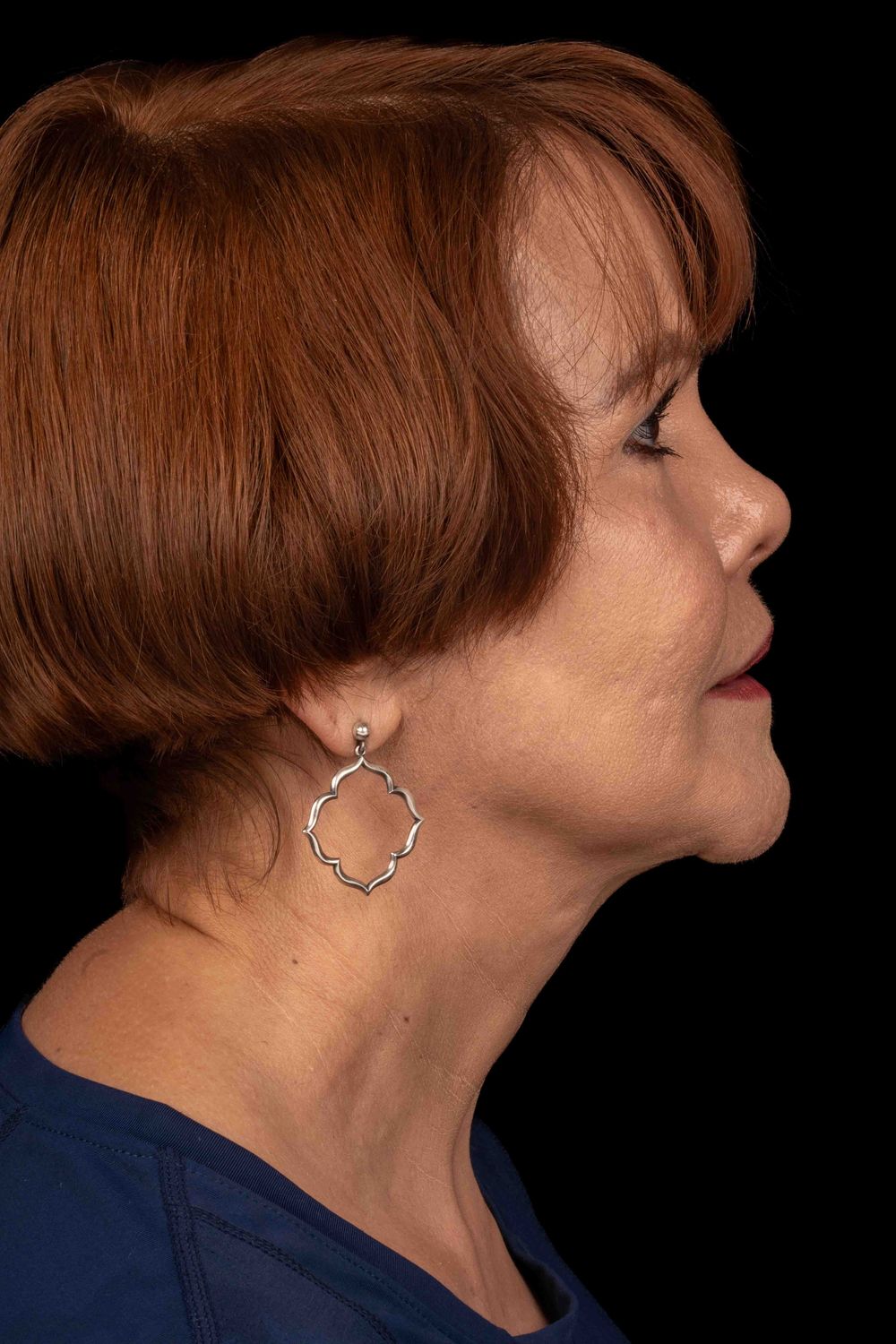 Facelift Before & After