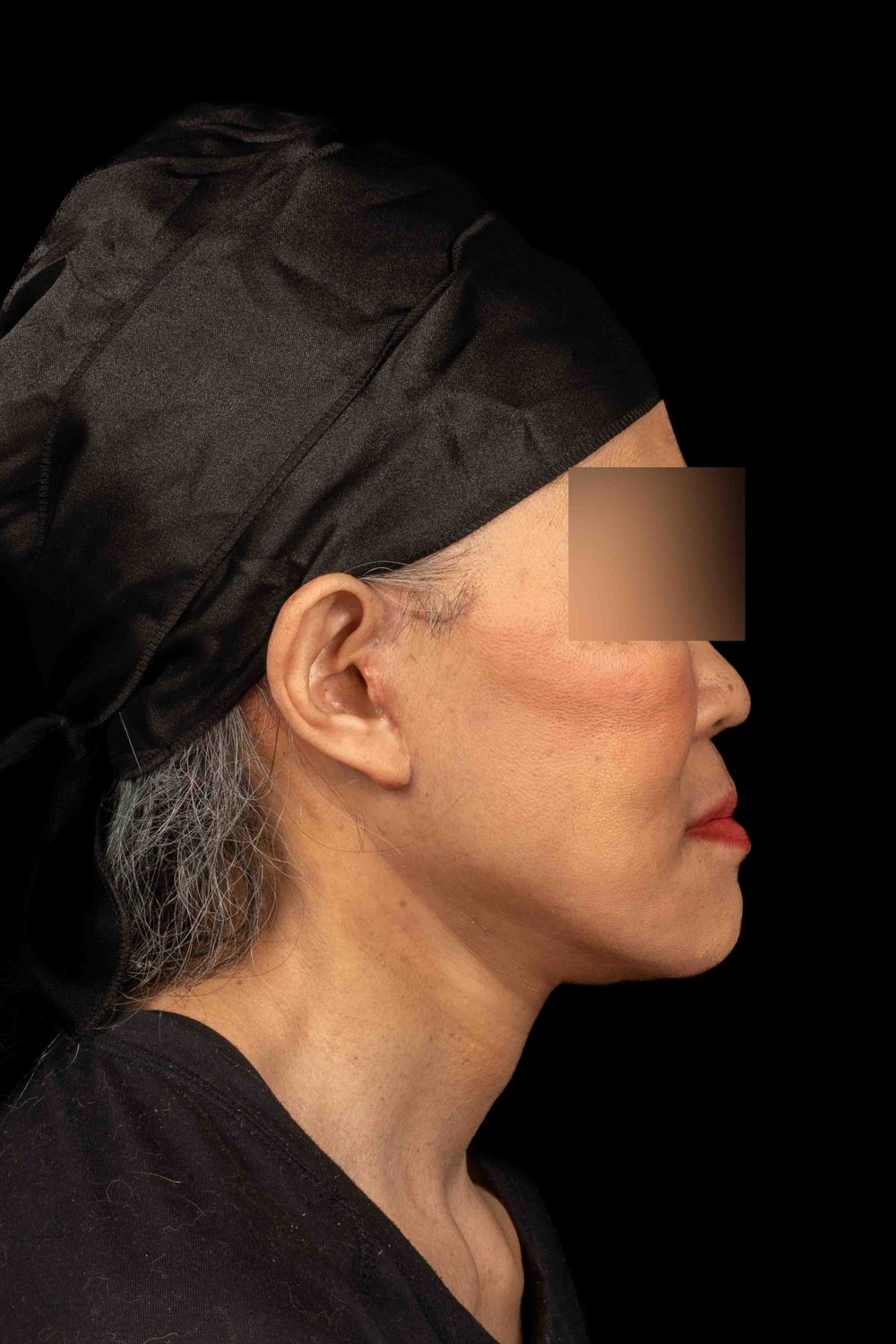 Facelift Before & After