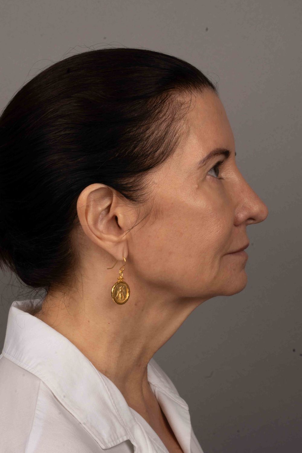 Facelift Before & After
