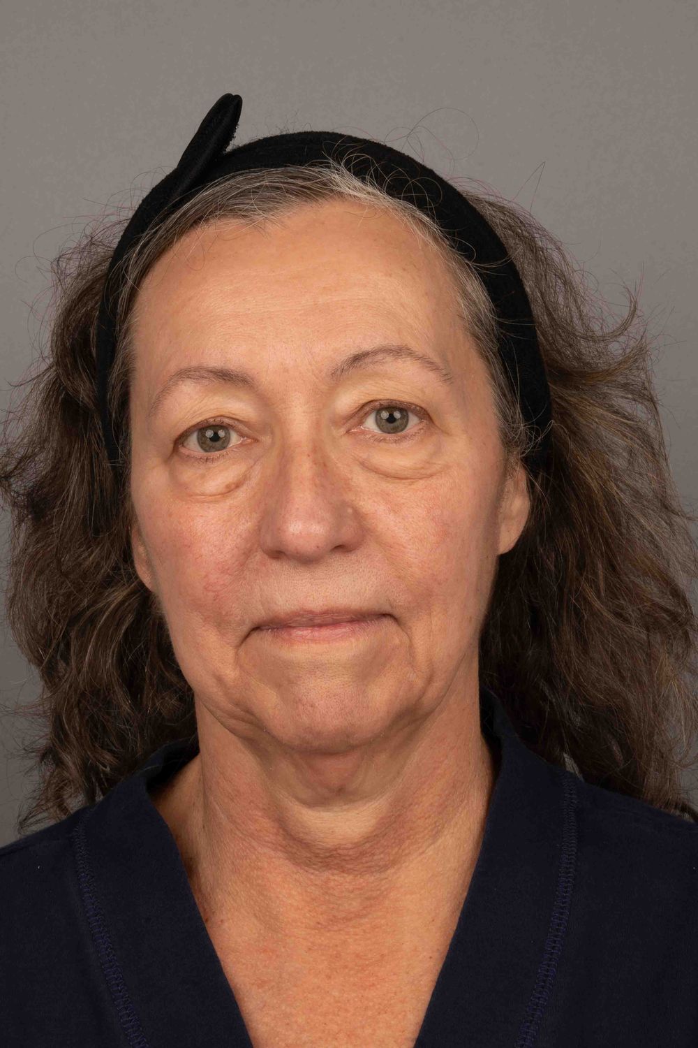 Facelift Before & After