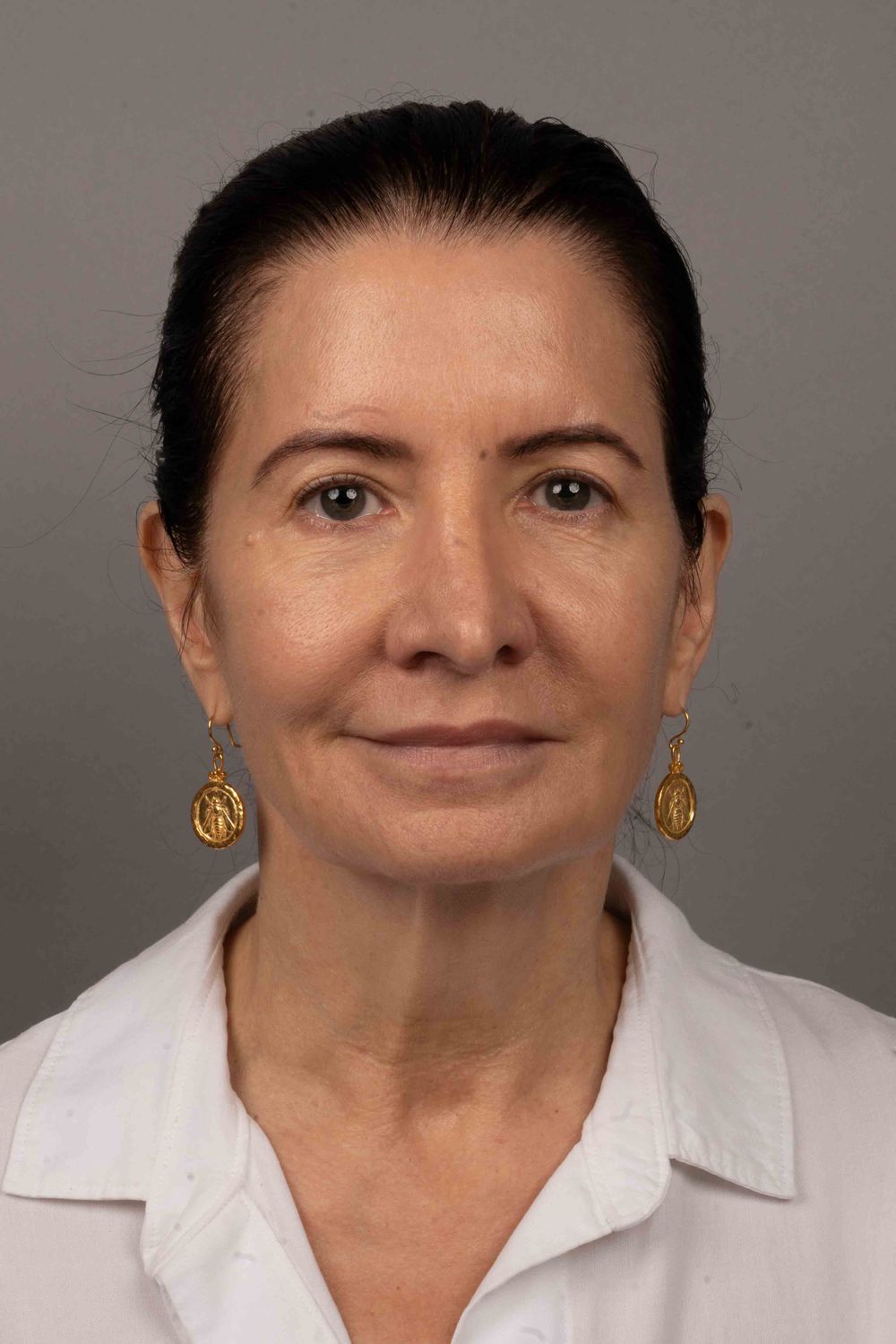 Facelift Before & After