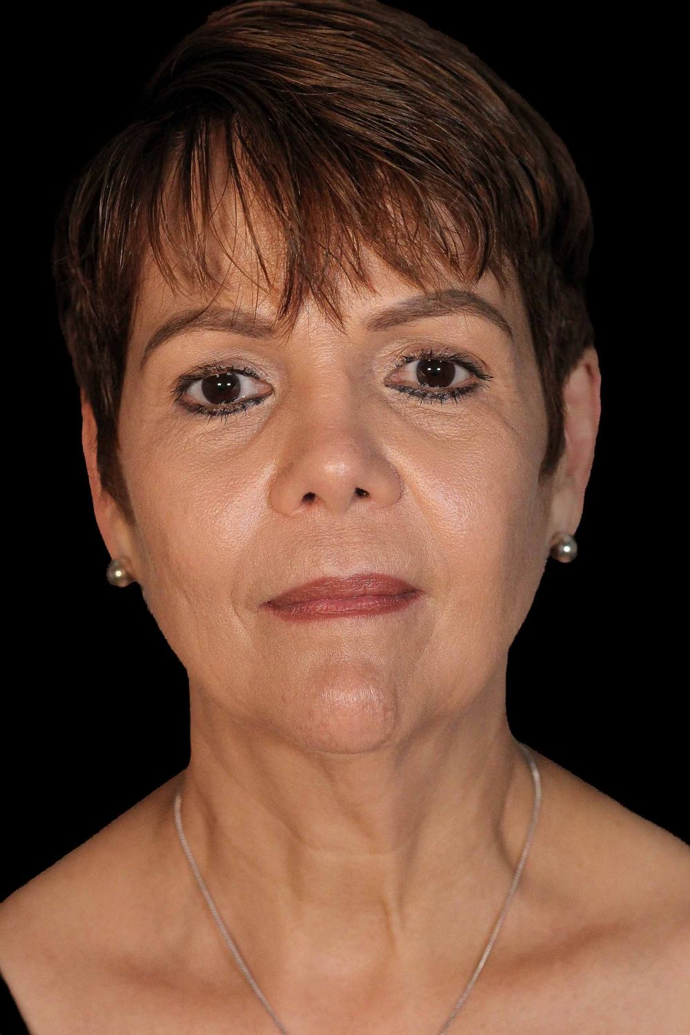 Facelift Before & After