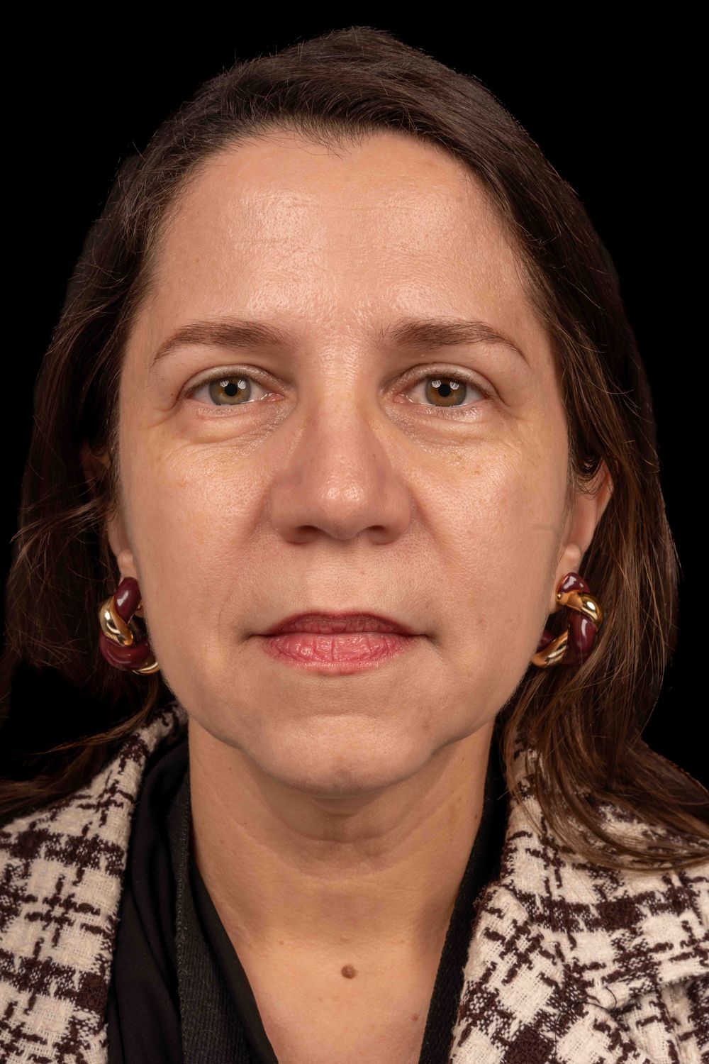 Facelift Before & After