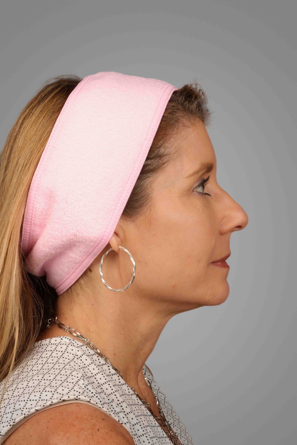 Facelift Before & After