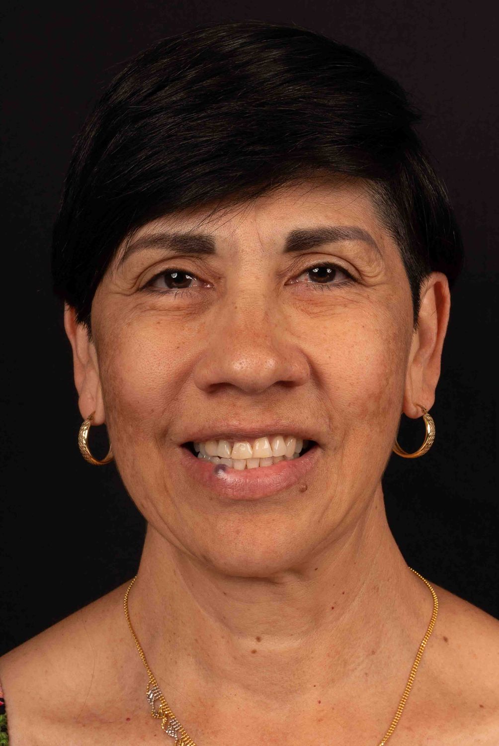 Facelift Before & After