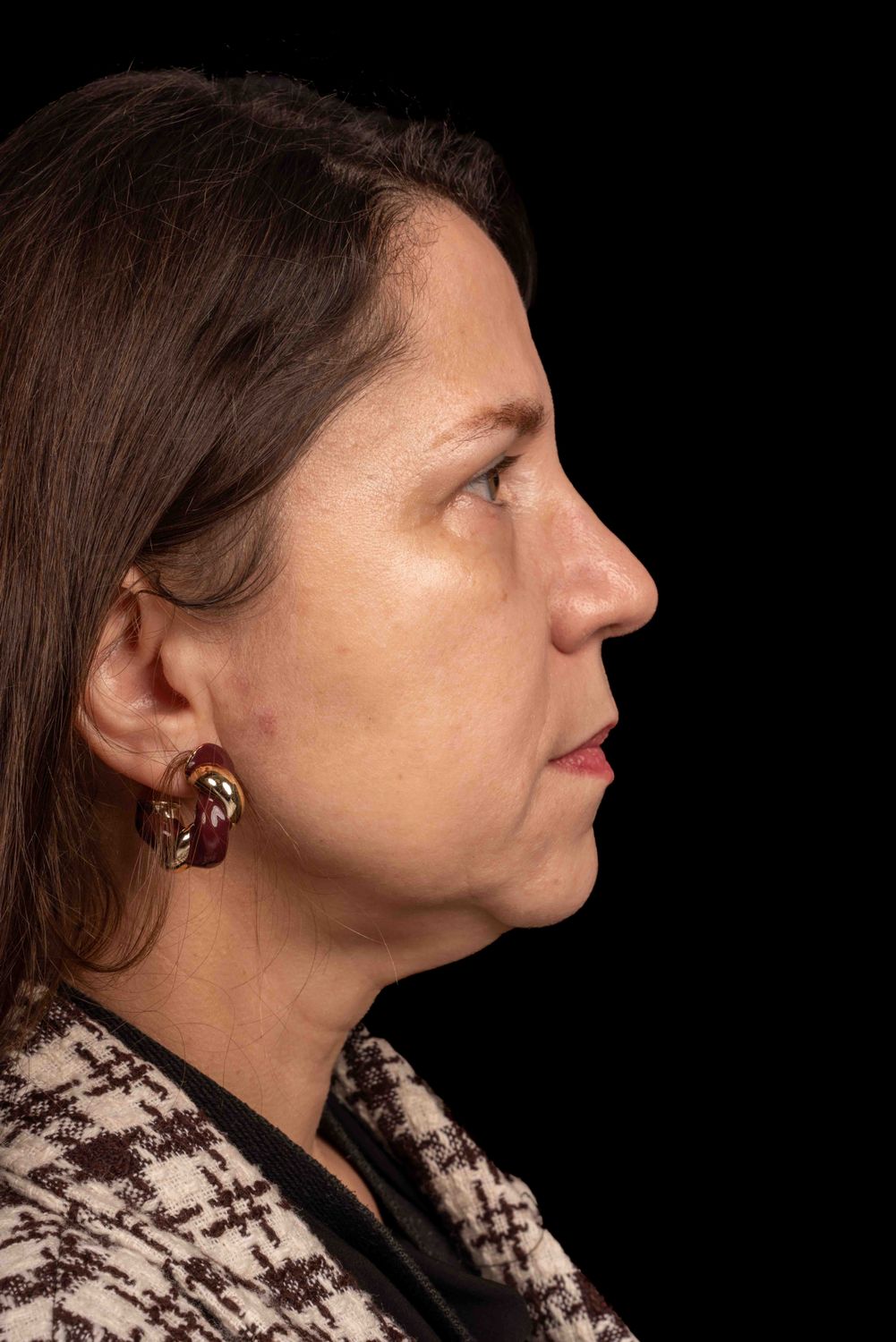 Facelift Before & After