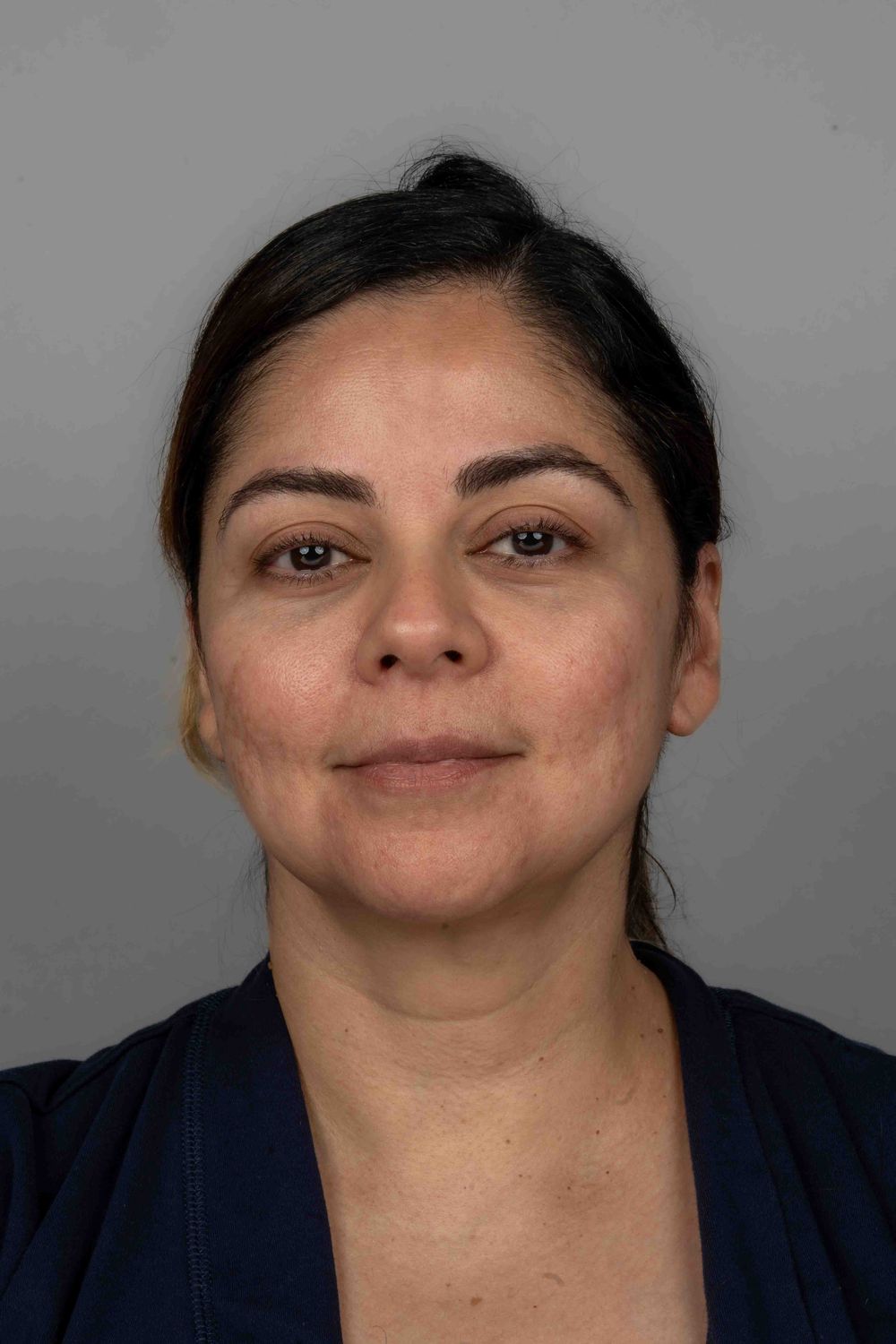 Facelift Before & After