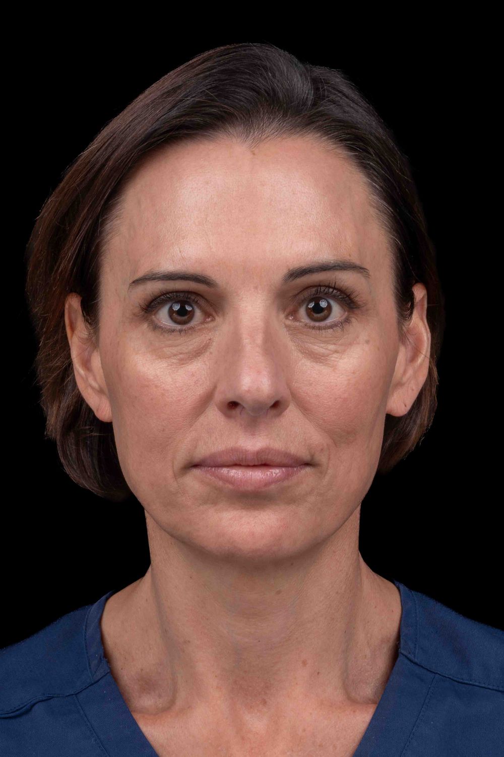 Facelift Before & After