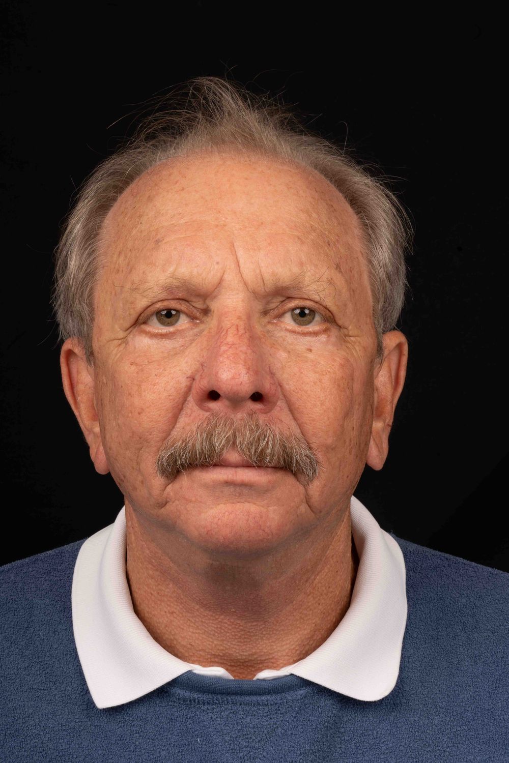 Facelift Before & After