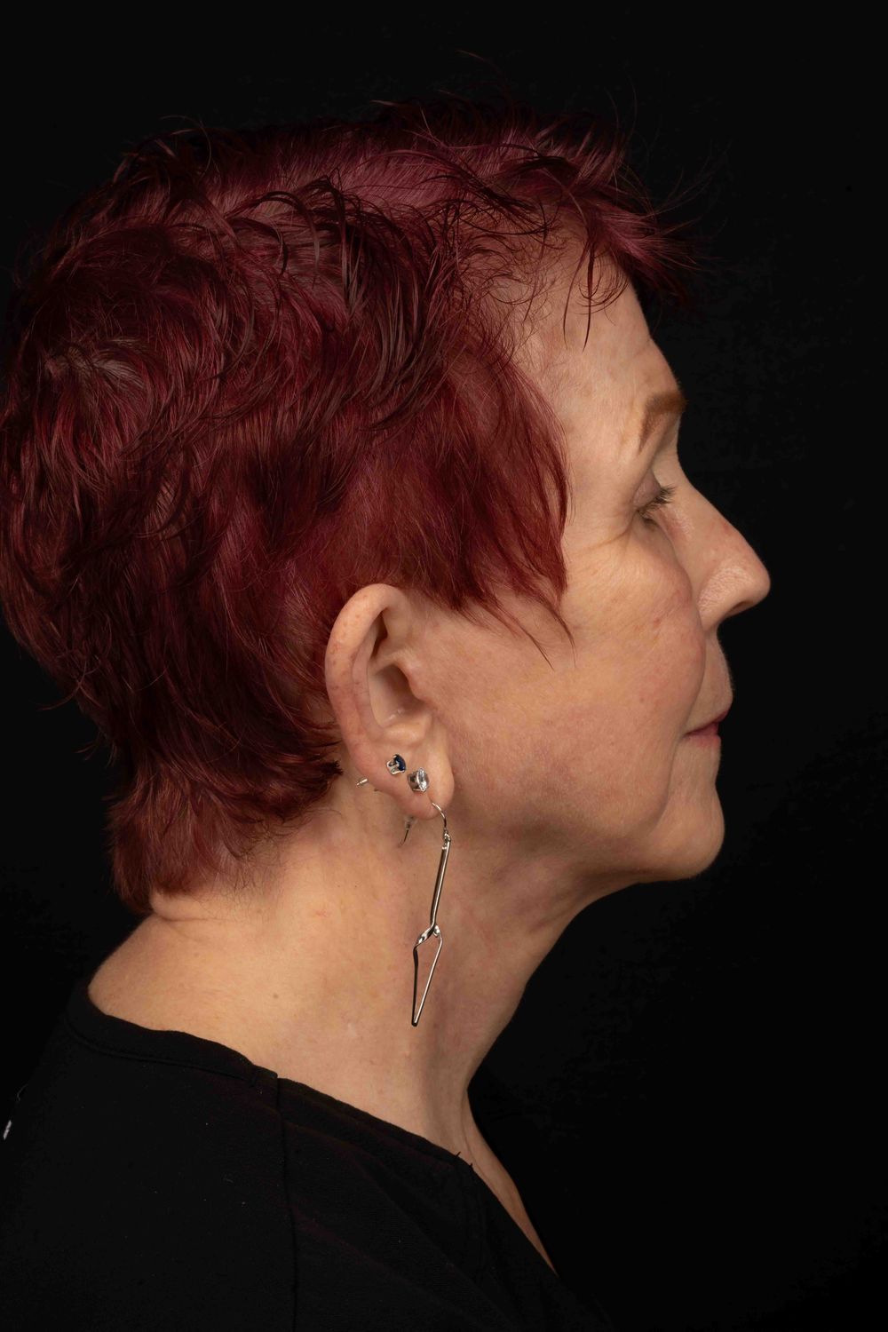 Facelift Before & After