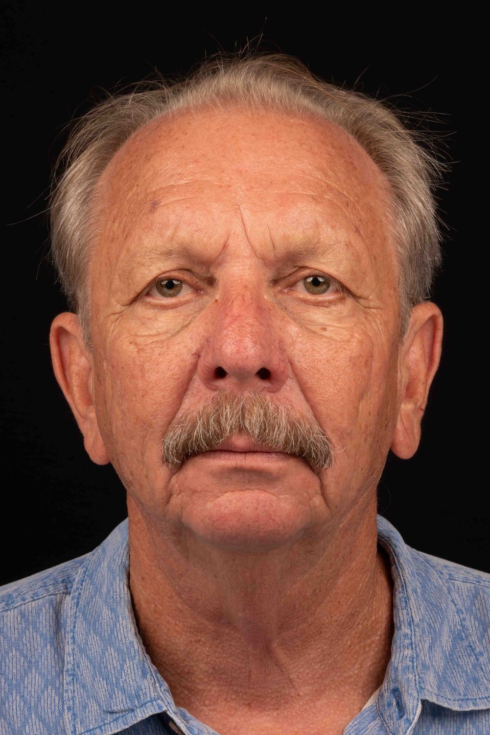 Facelift Before & After