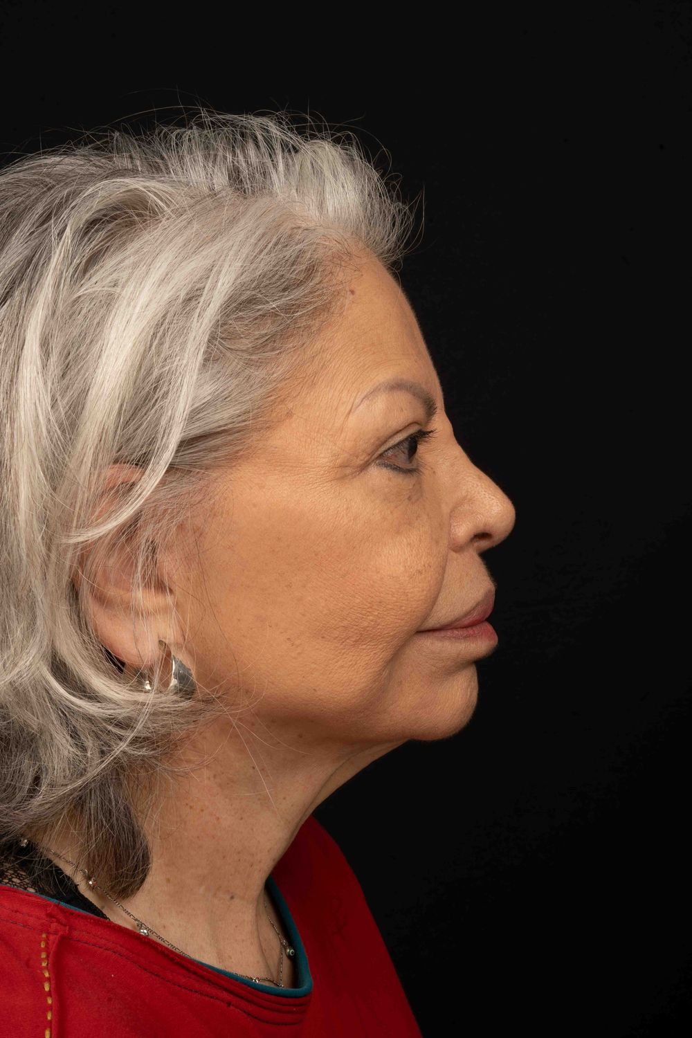 Facelift Before & After