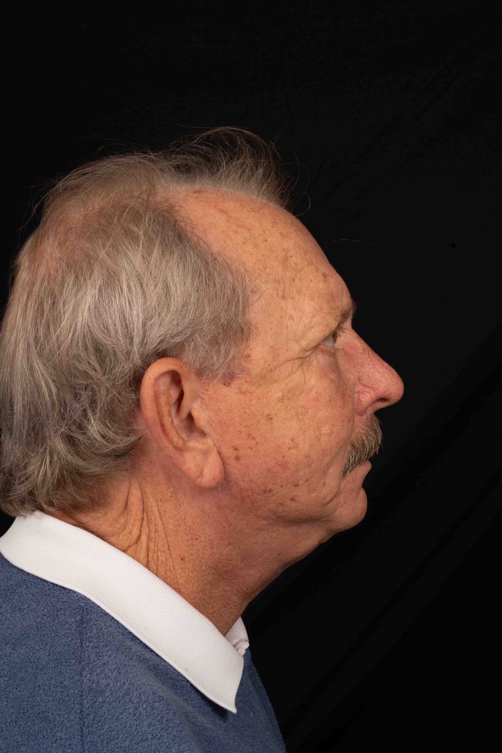 Facelift Before & After