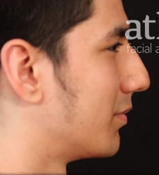 Chin Augmentation Before & After