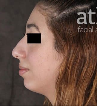 Chin Augmentation Before & After