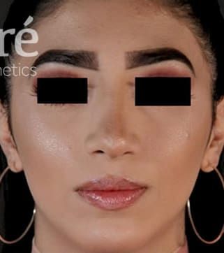 Chin Augmentation Before & After