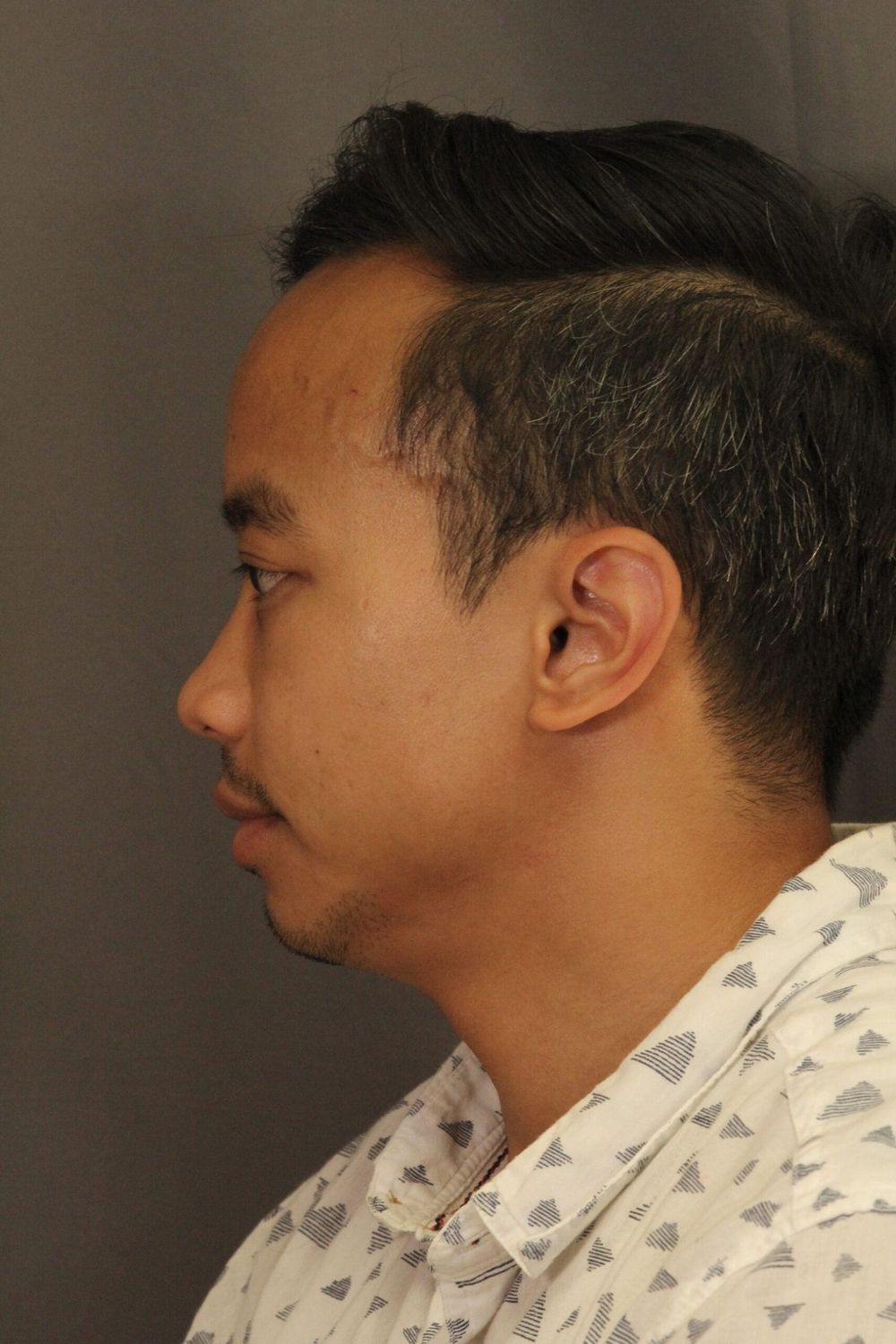 Chin Augmentation Before & After