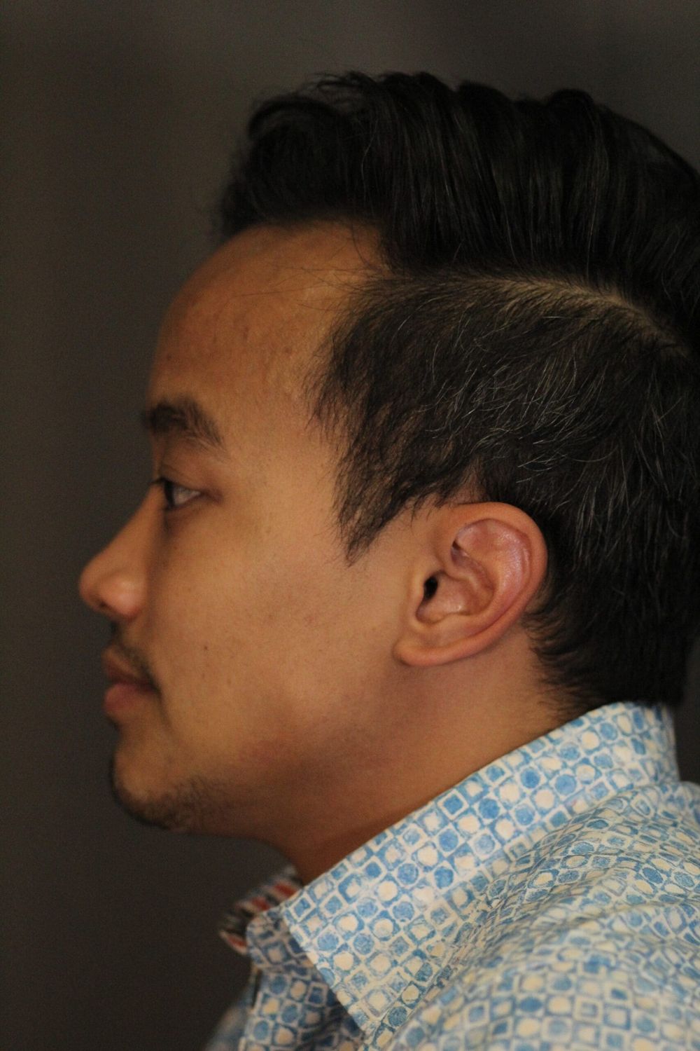 Chin Augmentation Before & After