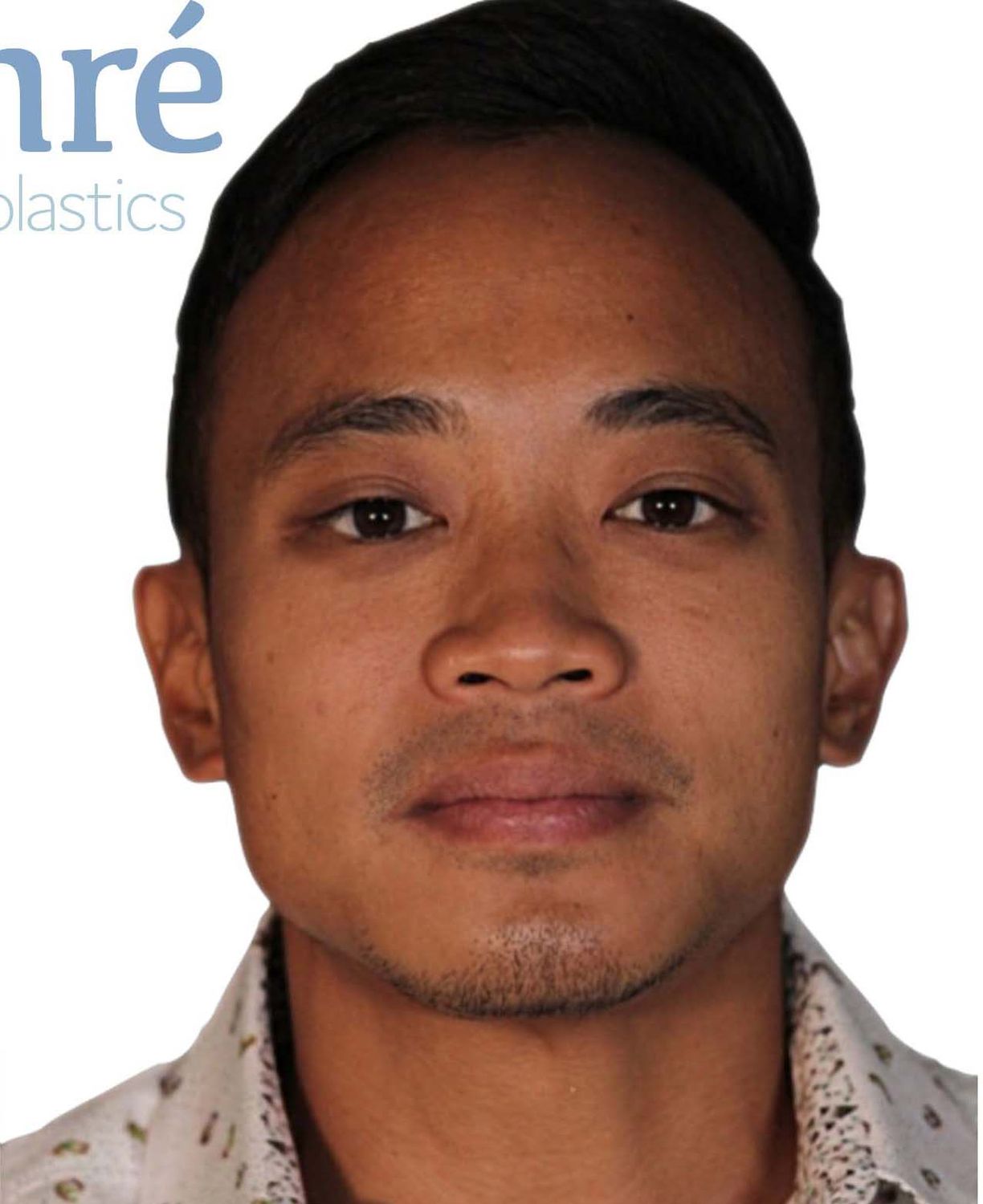 Chin Augmentation Before & After