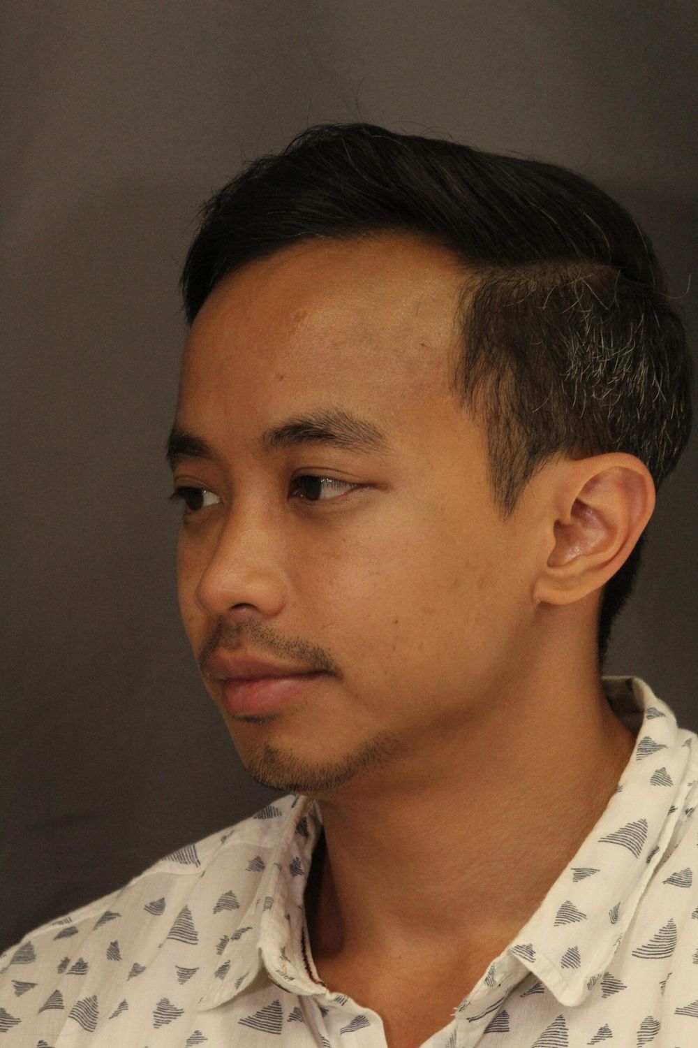 Chin Augmentation Before & After