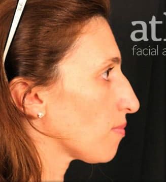 Chin Augmentation Before & After