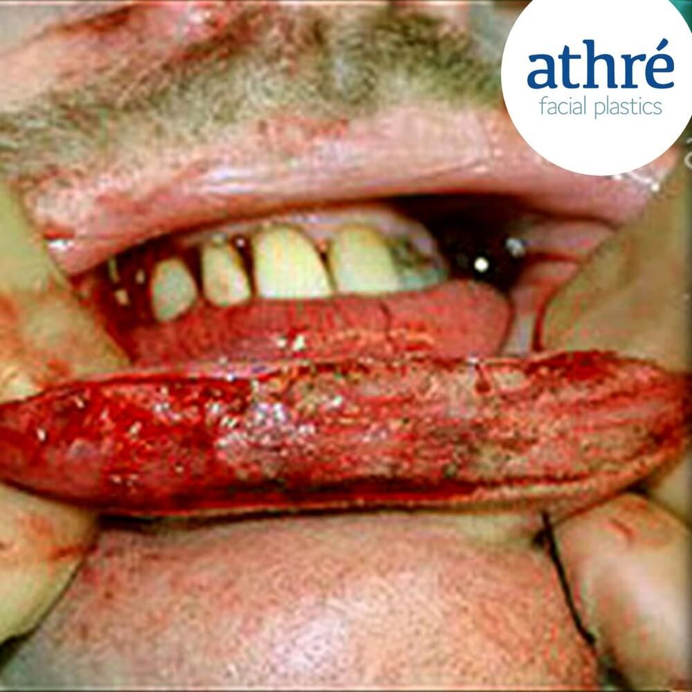 Skin Cancer Before & After