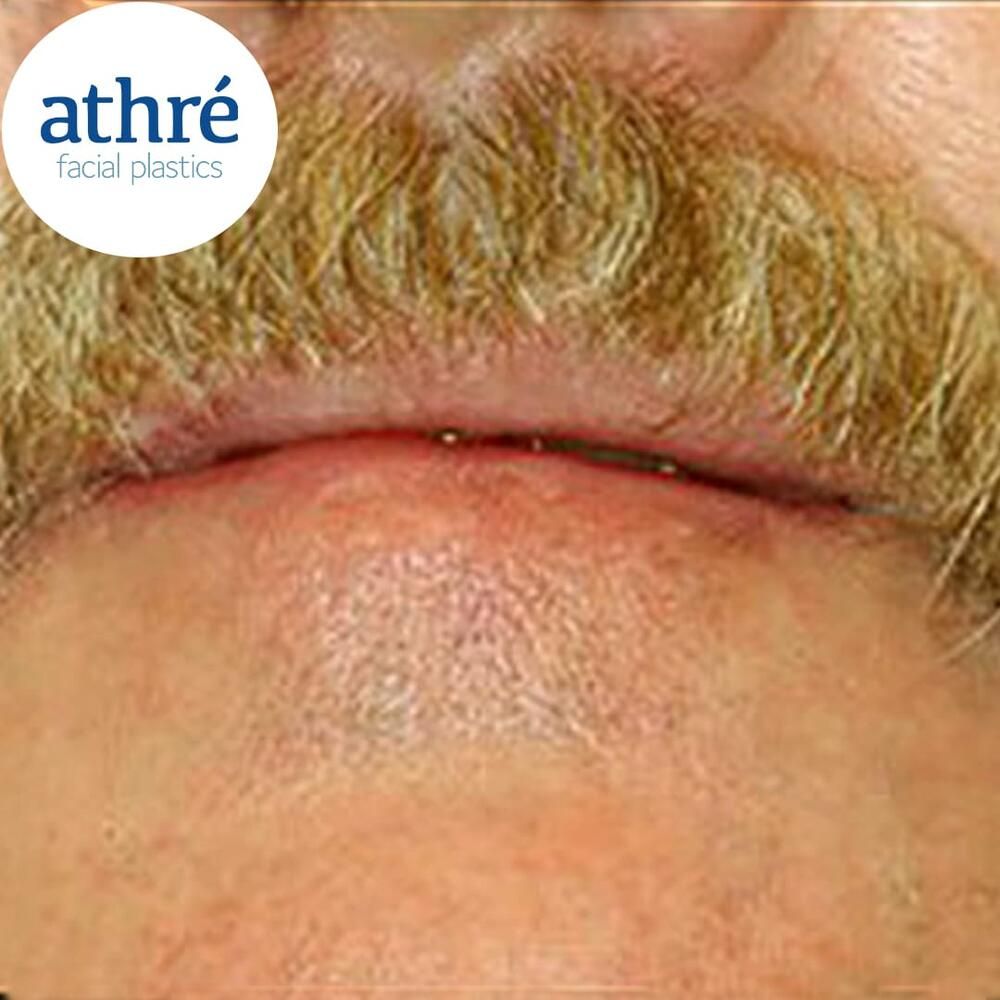 Skin Cancer Before & After