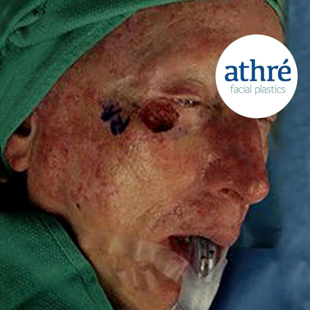 Skin Cancer Before & After