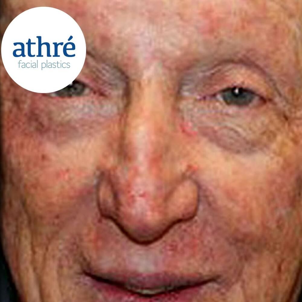 Skin Cancer Before & After