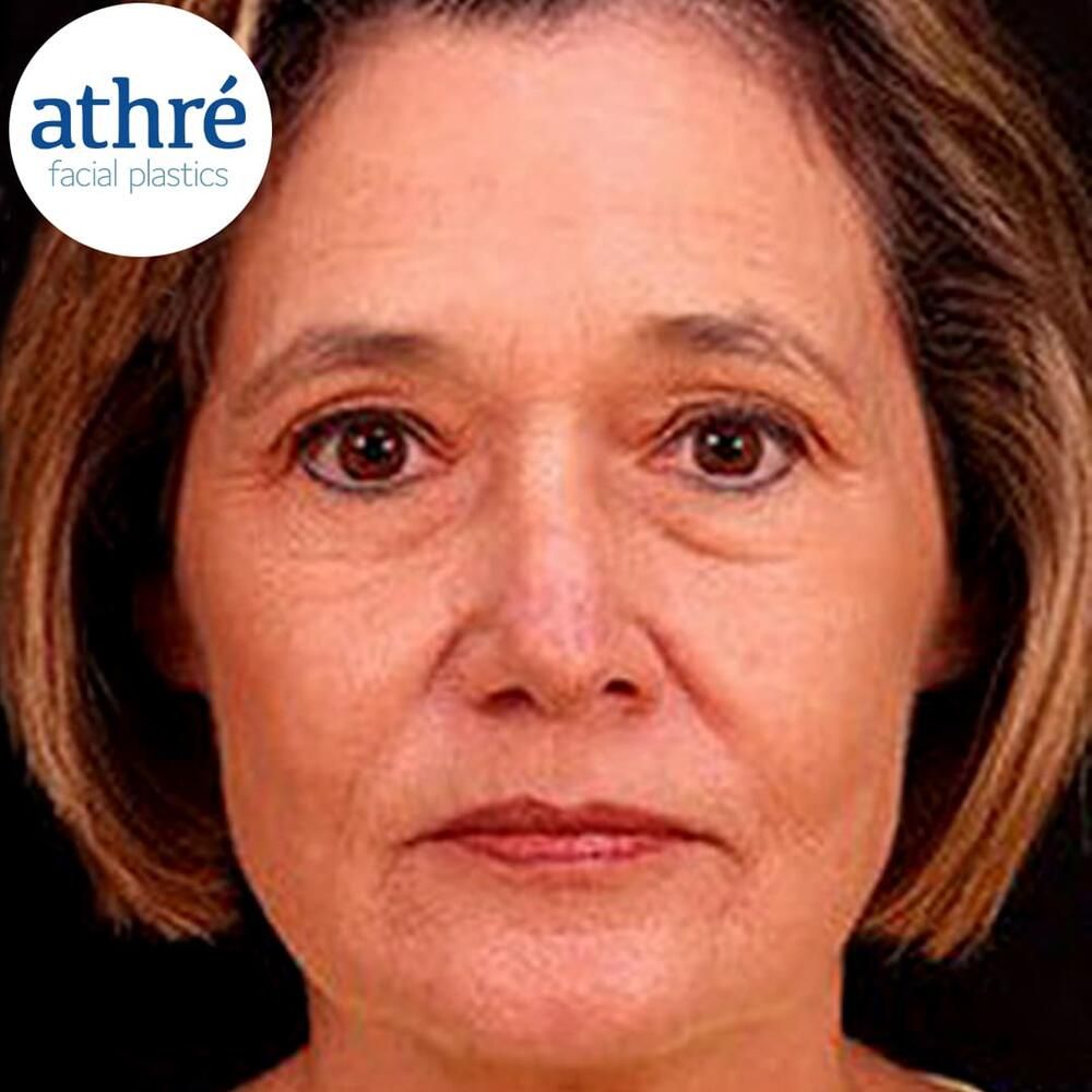 Skin Cancer Before & After