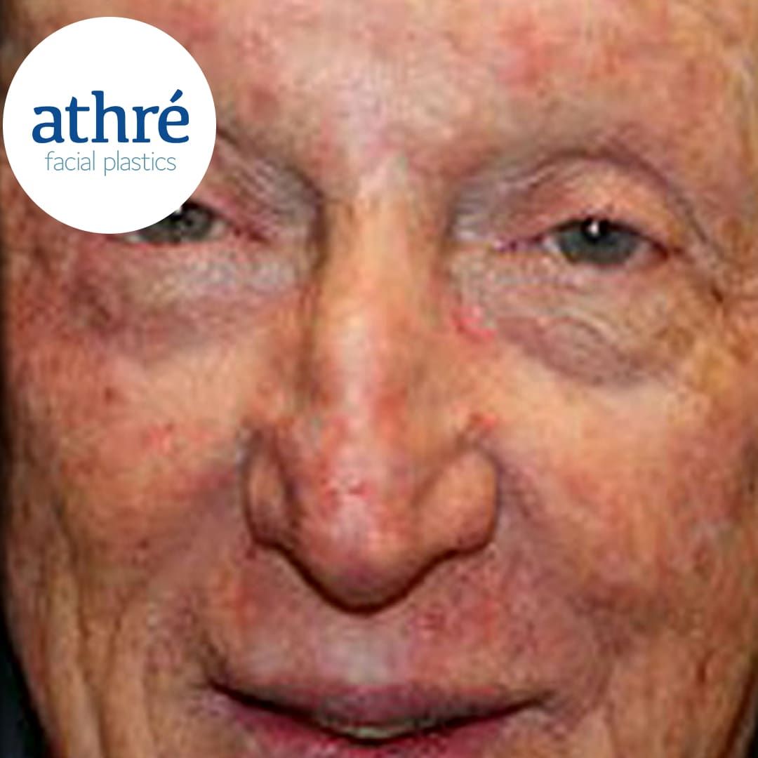 Eyelid Surgery Before & After