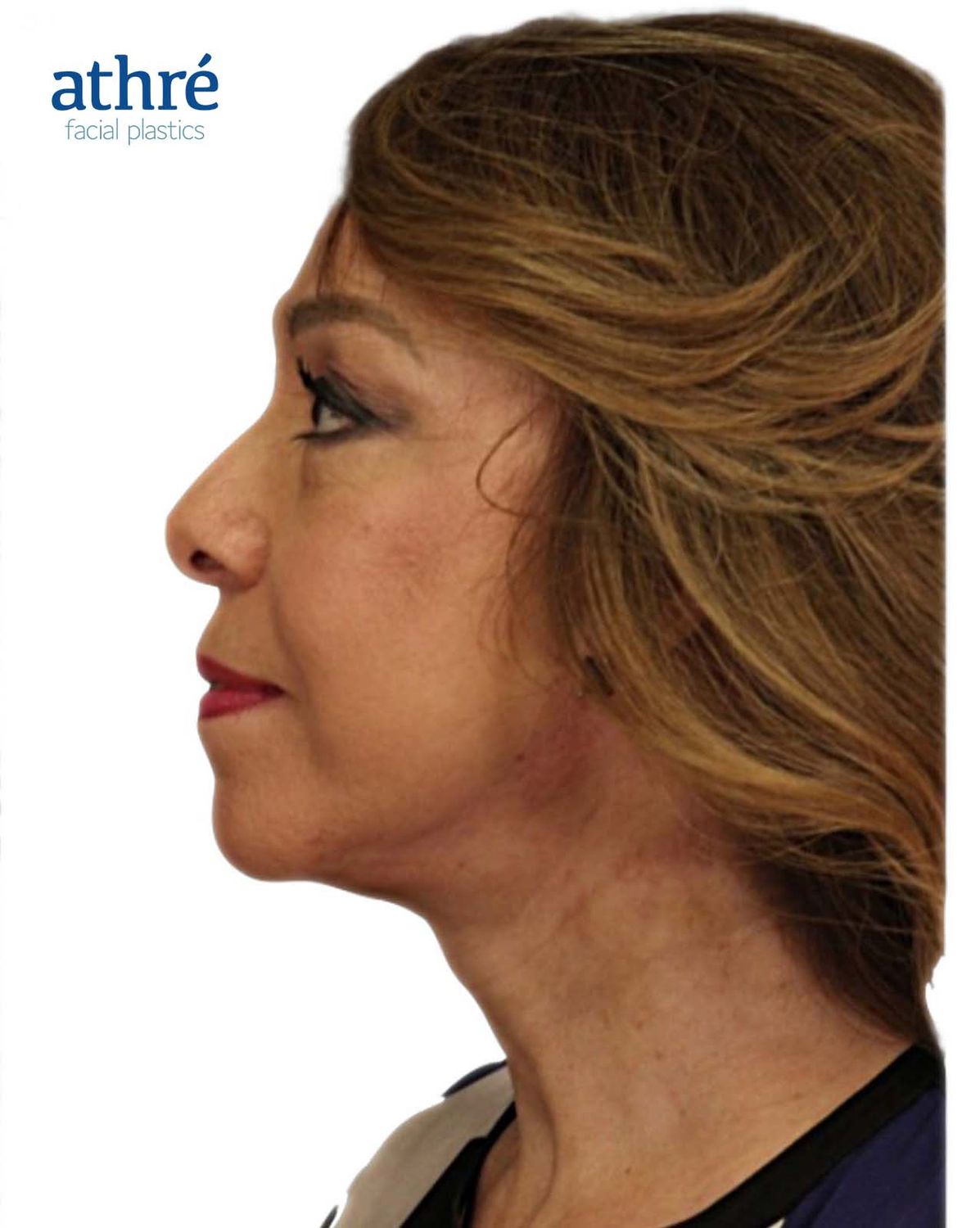 Eyelid Surgery Before & After