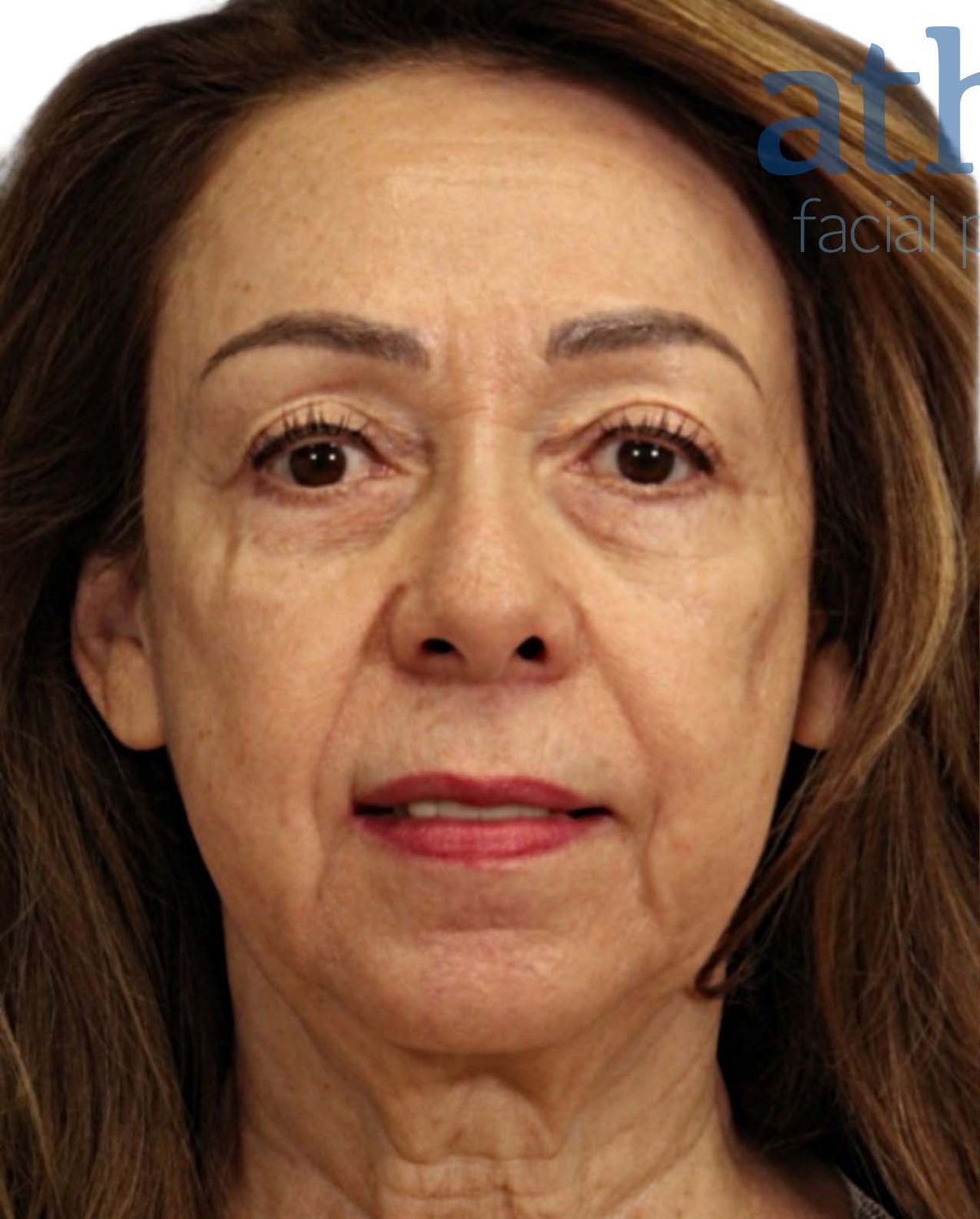 Eyelid Surgery Before & After