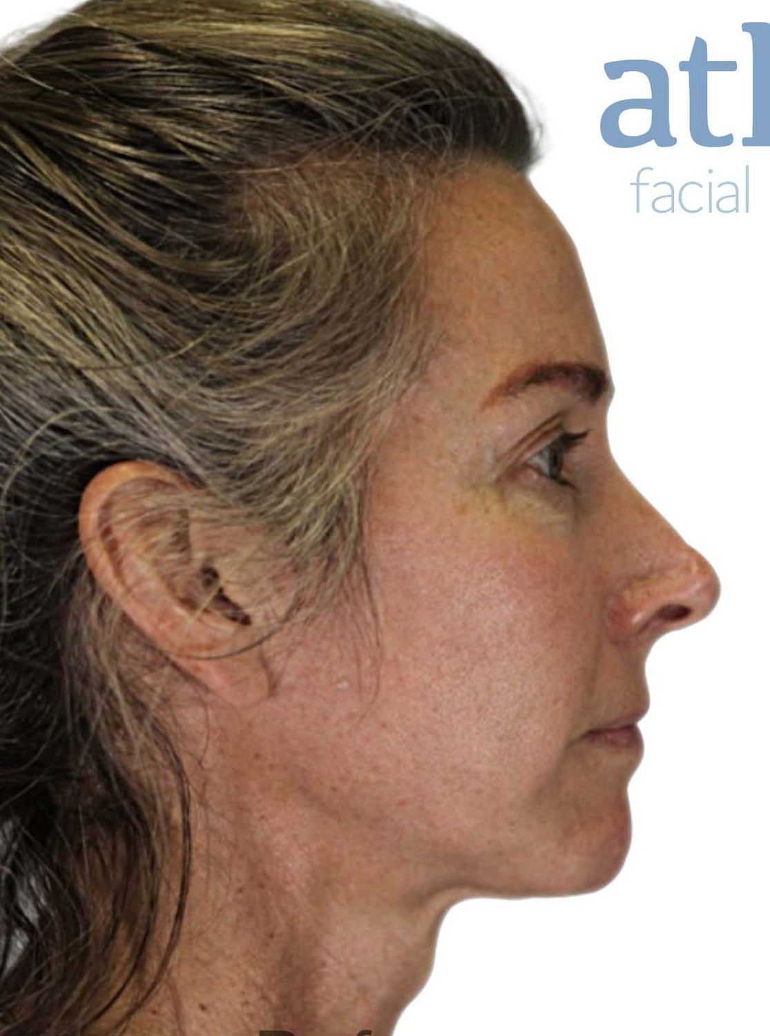 Eyelid Surgery Before & After