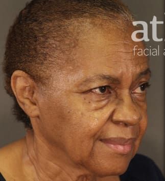 Eyelid Surgery Before & After