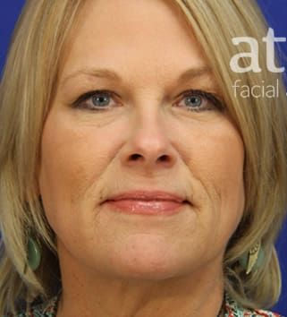 Eyelid Surgery Before & After