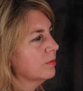 Eyelid Surgery Before & After